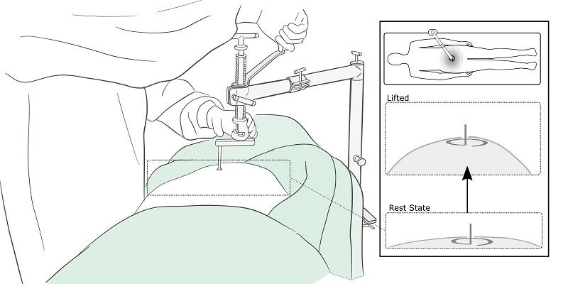 A graphic showing how the RAIS device mechanically lifts the abdominal wall. It shows the abdomen in a rest state and a lifted state