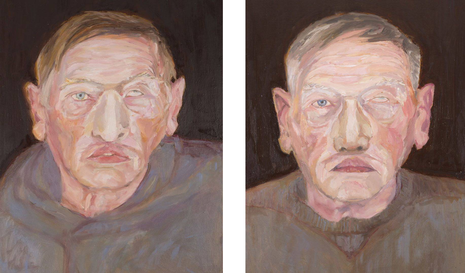 Side-by-side comparison paintings of David wearing Conventionally Manufactured and Digitally Manufactured Facial Prosthesis.