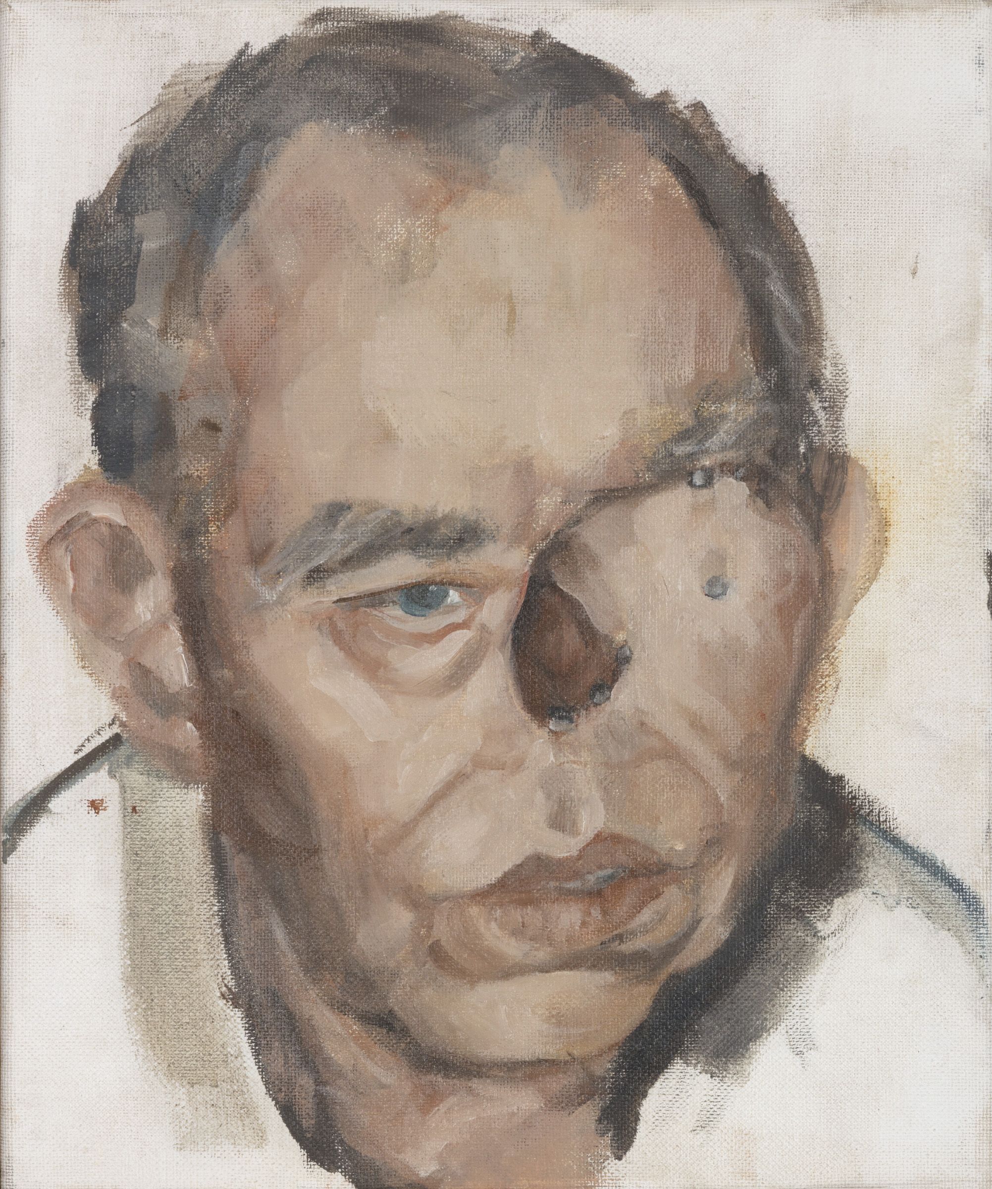 A study of Peter's face without his prosthesis showing the heads of the implants