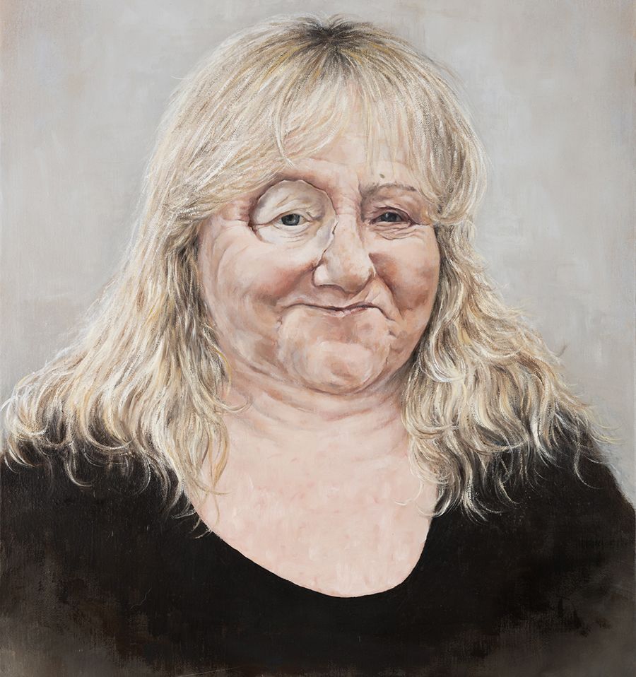 Painting of Suzie wearing her eye prosthesis and smiling