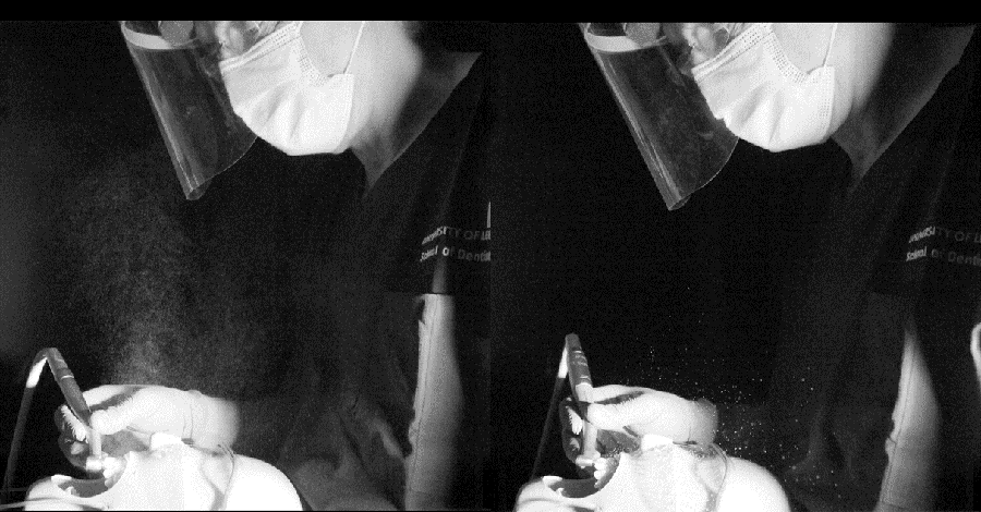 Two dummy mouths illustrating the difference in aerosol spray using turbine and electric drill handpieces. The turbine piece produces more spray.